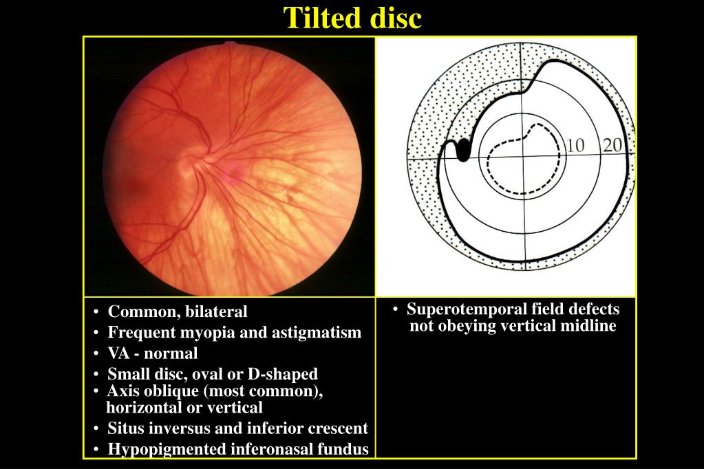  tilted Disc Syndrome 