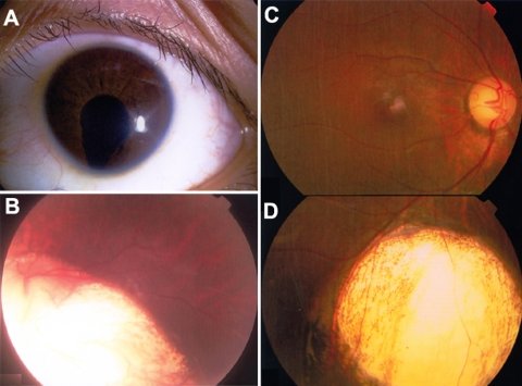 網脈絡膜欠損Coloidal coloboma | 自由が丘 清澤眼科