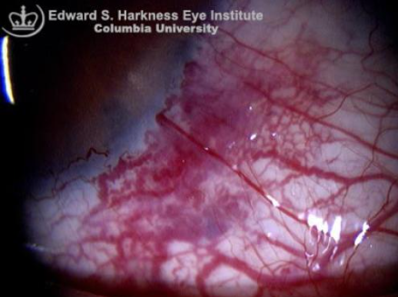結膜下出血の原因になる結膜血管腫とは 自由が丘 清澤眼科
