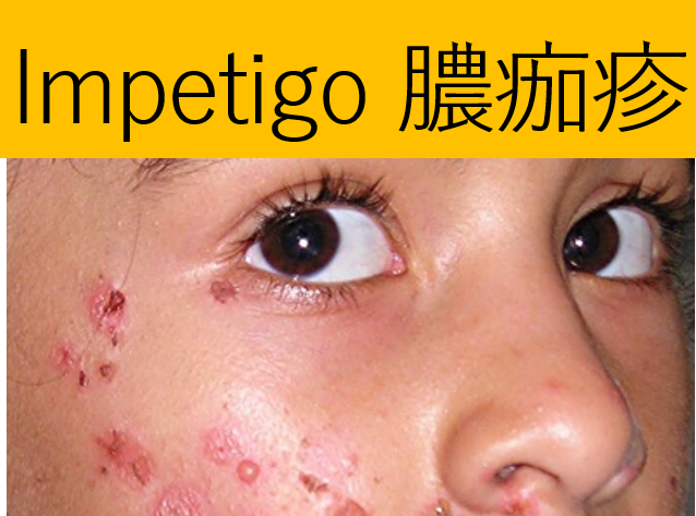 眼瞼にできるトビヒとは？(『impetigo』『伝染性膿痂疹』) | 自由が丘 清澤眼科